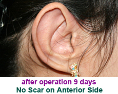 plastic-surgery-prominent-ear 